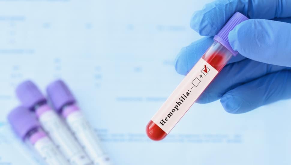 Doctor holding a test blood sample tube with positive Hemophilia test.