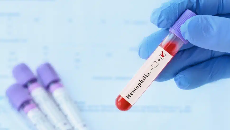 Doctor holding a test blood sample tube with positive Hemophilia test.
